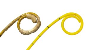 New hope for more than 5000 ureteral stent patients daily