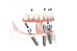 Wilmslow All-On-4 Dental Implants Private Dentist Dr Natasja Kashyap Recommends Consultations at The Croft Dental & Implant Practice